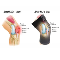 Pickleballsports OS1st  KS7+ Adjustable Performance Knee Sleeve